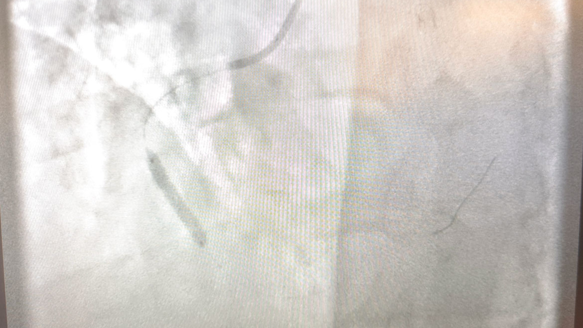 Στεφανιαία Αγγειοπλαστική (Τοποθέτηση Stent)