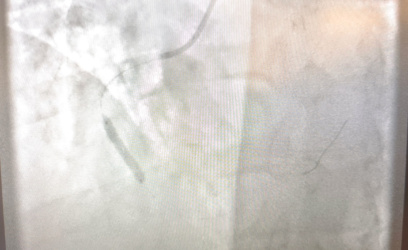 Στεφανιαία Αγγειοπλαστική (Τοποθέτηση Stent)