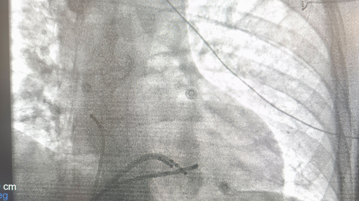 Ablation για υπερκοιλιακές & κοιλιακές αρρυθμίες