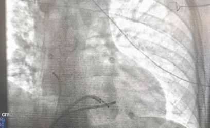 Ablation για υπερκοιλιακές & κοιλιακές αρρυθμίες